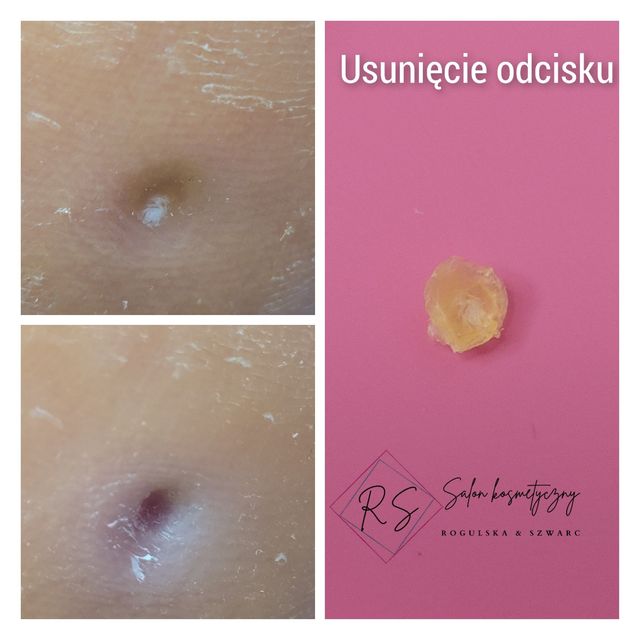 Usunięcie odcisku