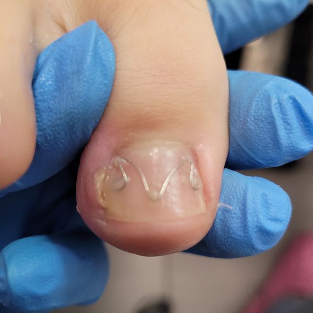 Pedicure leczniczy